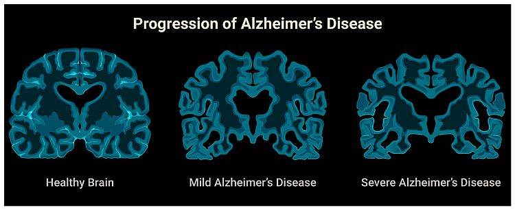 Alzheimer Disease