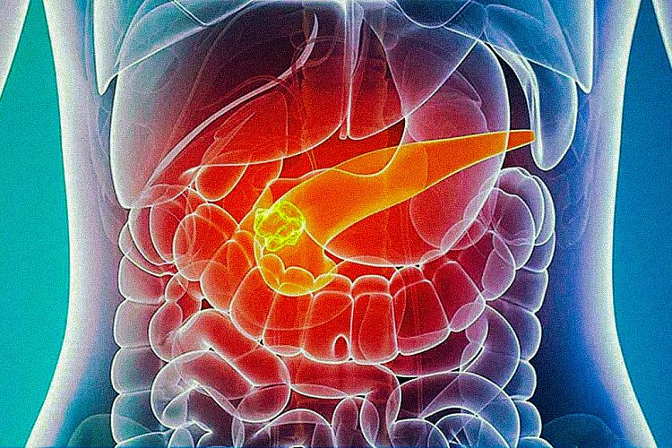 Neuroendocrine Tumors