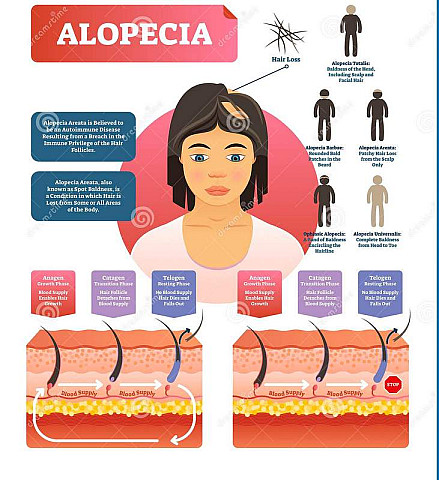 Alopecia-diseas5