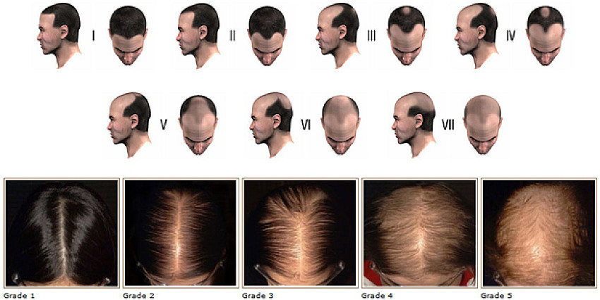 Alopecia-disease4