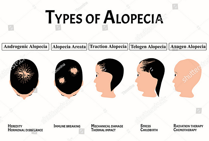 Alopecia8