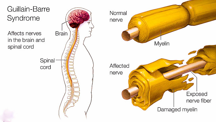 Guillain-Barre-Syndrome