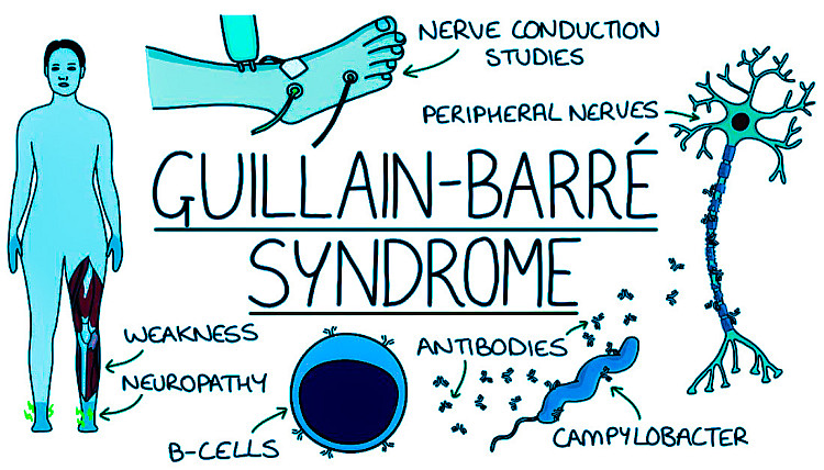 Guillain-Barre-Syndrome-Disease