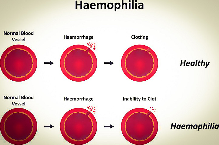 Haemophilia1