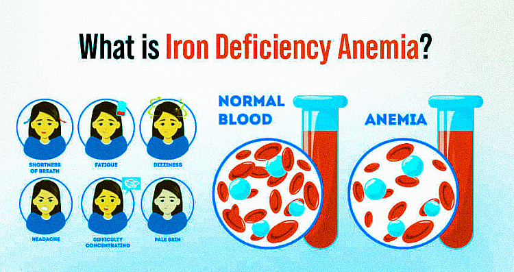 What Is Iron Deficiency Anemia, Sign & Symptoms, Causes, Diagnosis, And ...