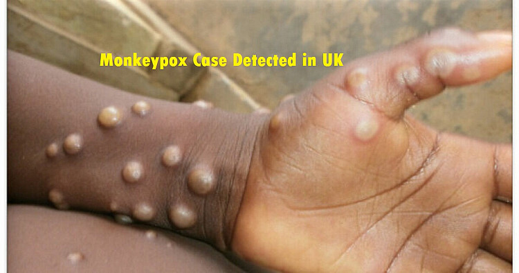 Monkeypox