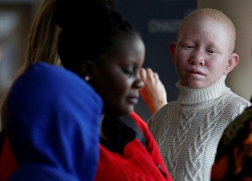 International Albinism Awareness Day