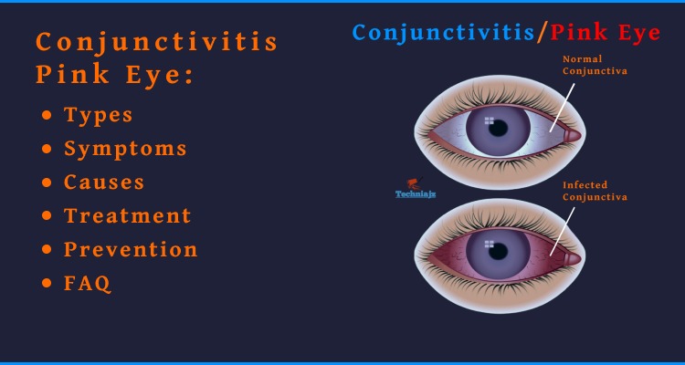 Pink Eye or Conjunctivitis