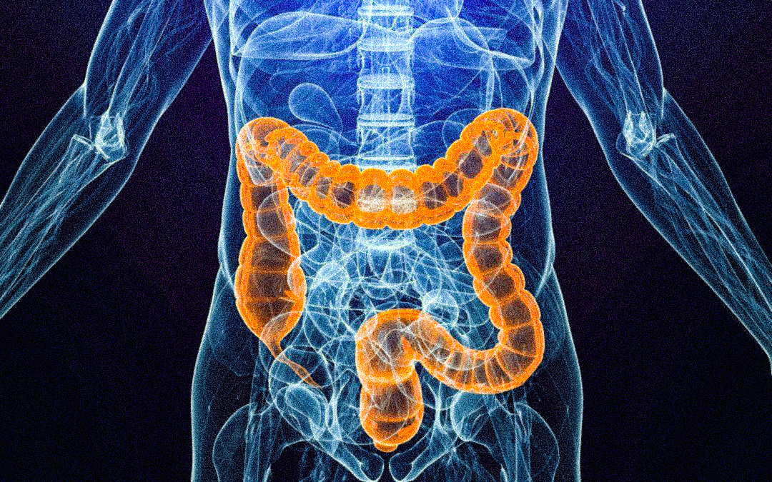 Is Colon Cancer Chronic Or Acute